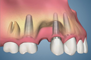 Bone Loss Around Implant-Unattached